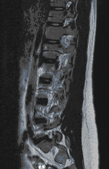 Bandscheibenvorfall Bandscheibenvorfall