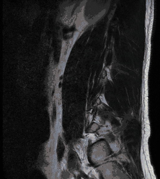 Gelenkzyste Gelenkzyste