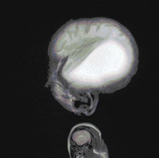 Hydrozephalus Hydrozephalus