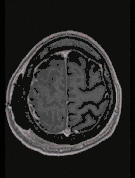 Oligodendrogliom Oligodendrogliom