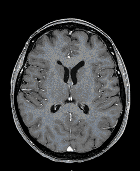 Schaedelbasis_Meningeom Schaedelbasis_Meningeom